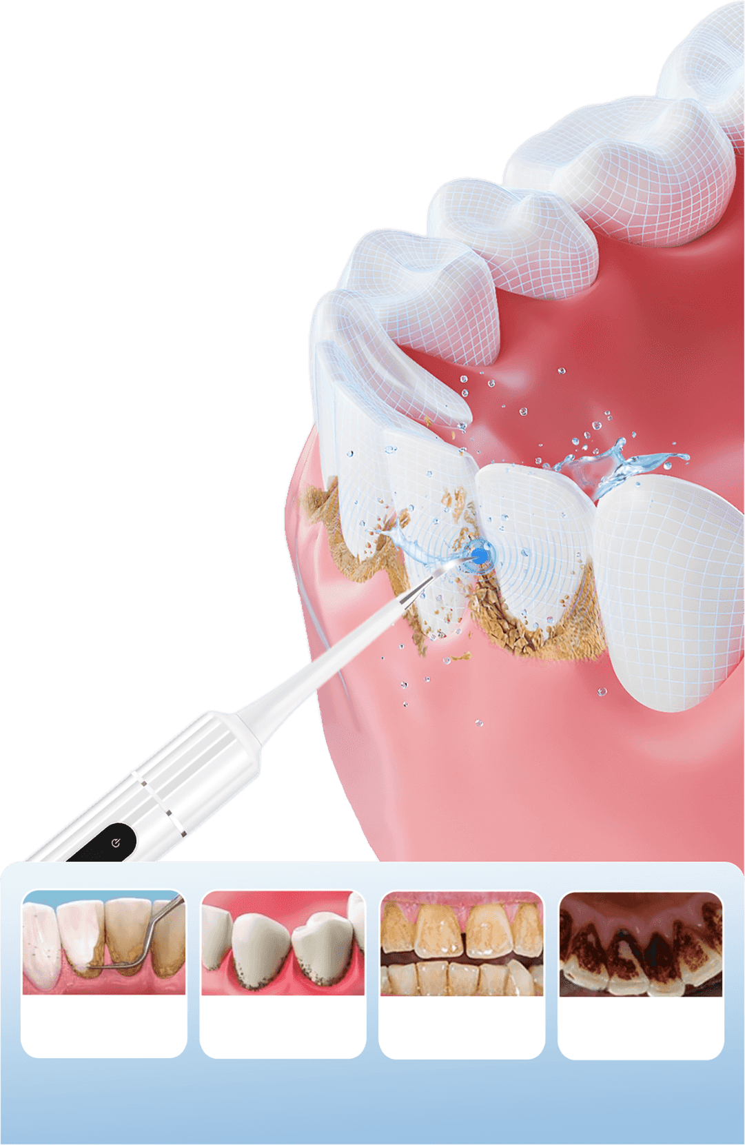 Ultraljuds vattenflosser – effektiv borttagning av plack och djuprengöring av tänderna