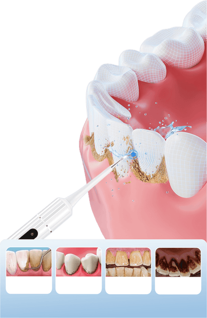 Ultraljuds vattenflosser – effektiv borttagning av plack och djuprengöring av tänderna